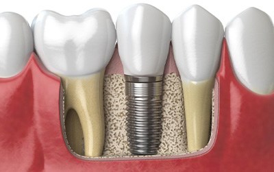 a 3D illustration of a dental implant in the jawbone