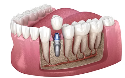 Illustration of single dental implant