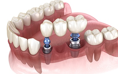 Illustration of dental bridge