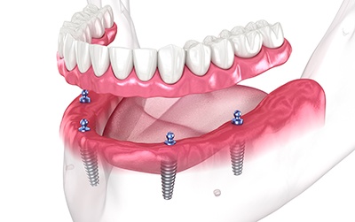 Illustration of implant denture