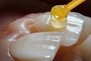 Veneer being put onto a tooth